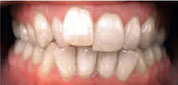 invisalign-1