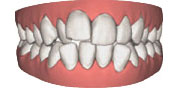 invisalign-2