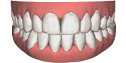 invisalign-4