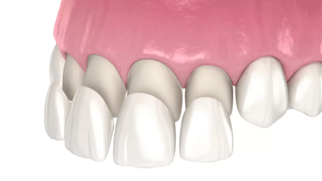 Porcelain Veneers